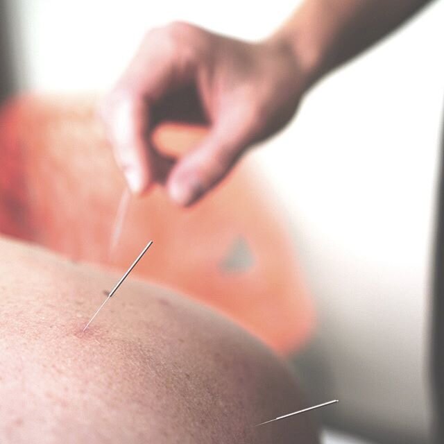 How does acupuncture reduce stress?
⠀⠀⠀⠀⠀⠀⠀⠀⠀
#Acupuncture decreases stress by releasing endorphins i.e. natural pain killer chemicals in the brain. 😉 This therapy improves blood circulation throughout the body and boosts the amount of oxygen in tis