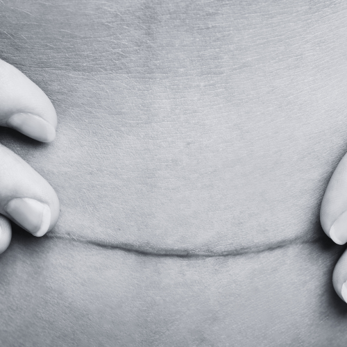 C section scar.png