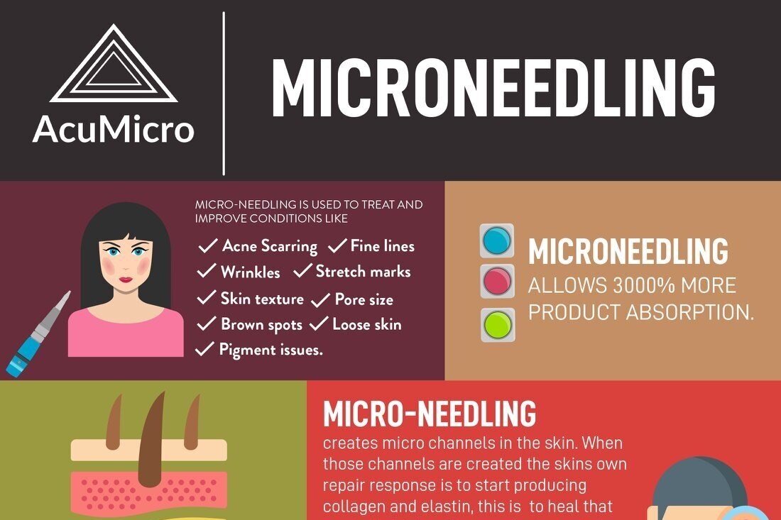 Facial acupuncture, microneedling, and how can it help you with your youthful glow?