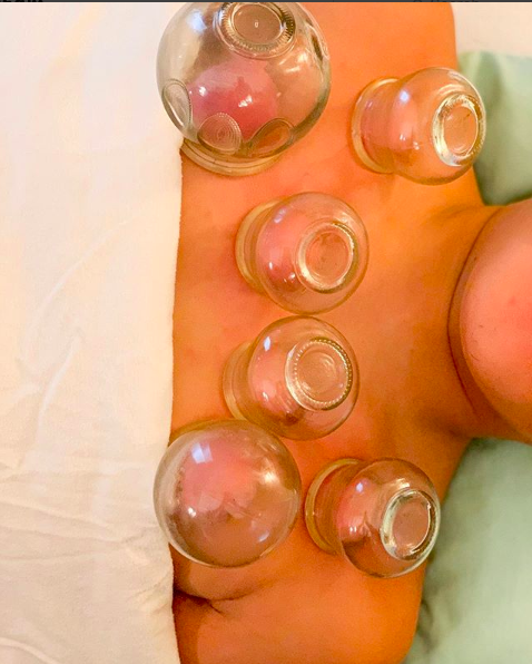 Cupping for anxiety
