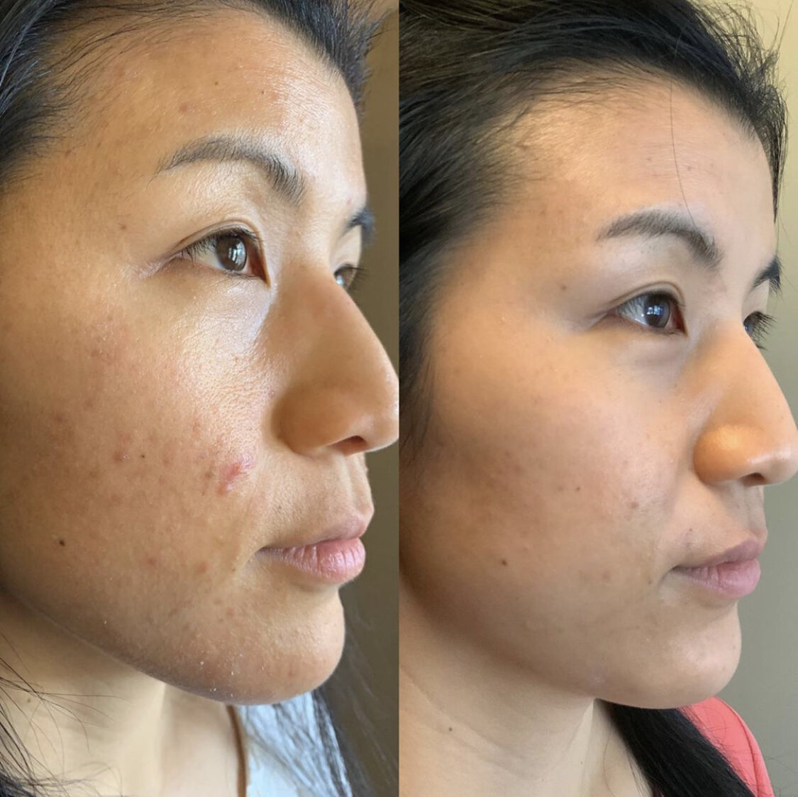 Eliminate and get clear skin with and acupuncture — Road To | Los Gatos Acupuncture