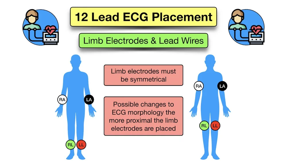 12 Lead ECG Placement Diagram and Mnemonic for Limb and Precordial