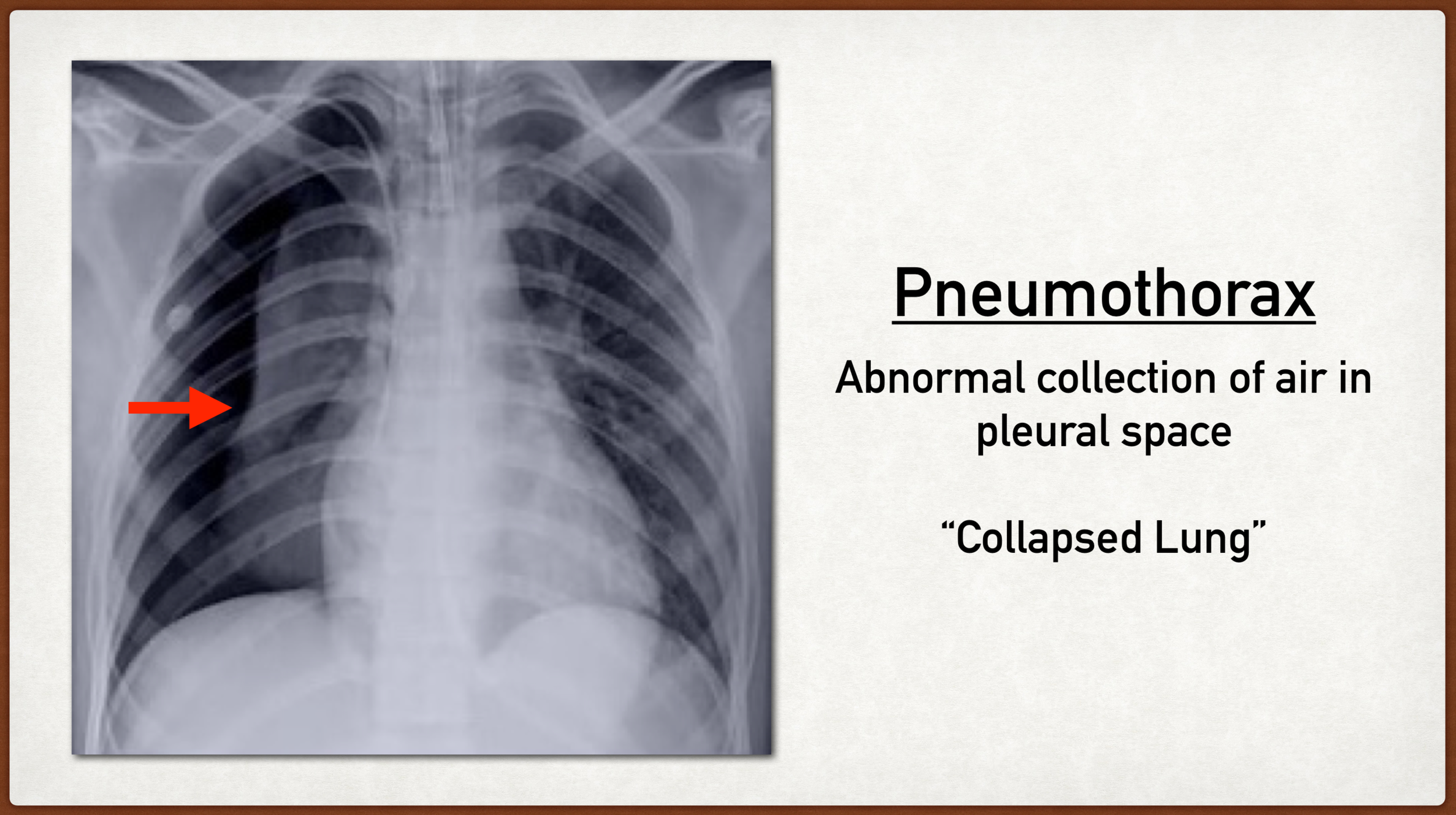 Pneumothorax Symptoms, Diagnosis