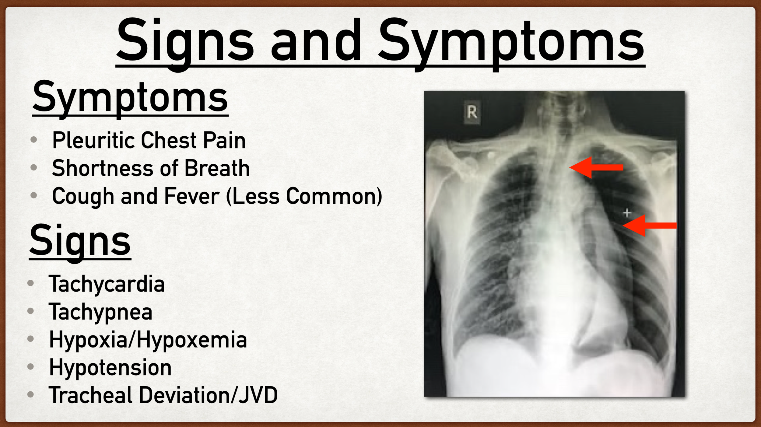 PT" Trick for Pneumothorax Types, Symptoms, Risk Factors, Causes, and Treatment of Collapsed Lung — EZmed