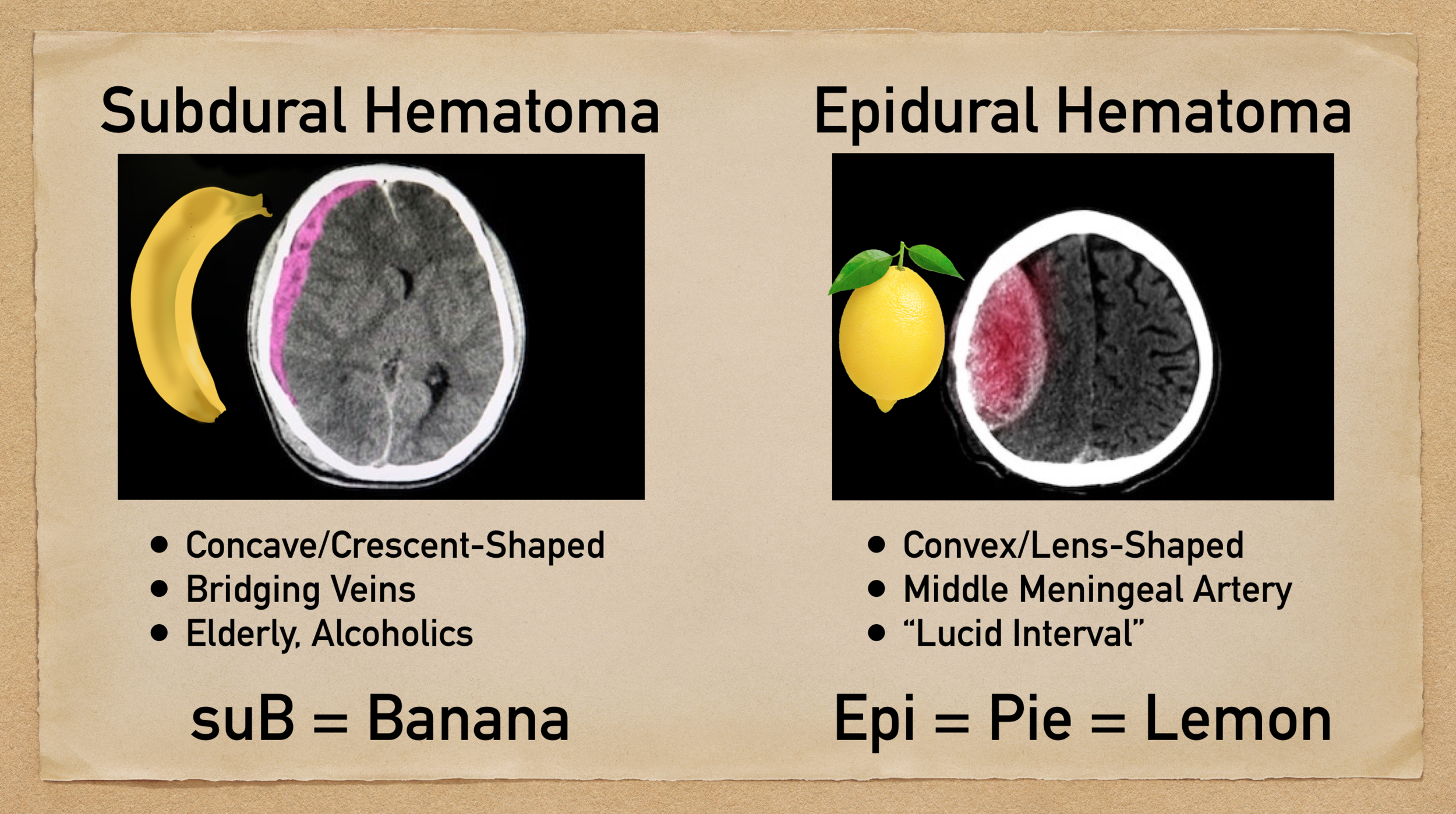 Hematoma vs subdural hematoma epidural Epidural vs