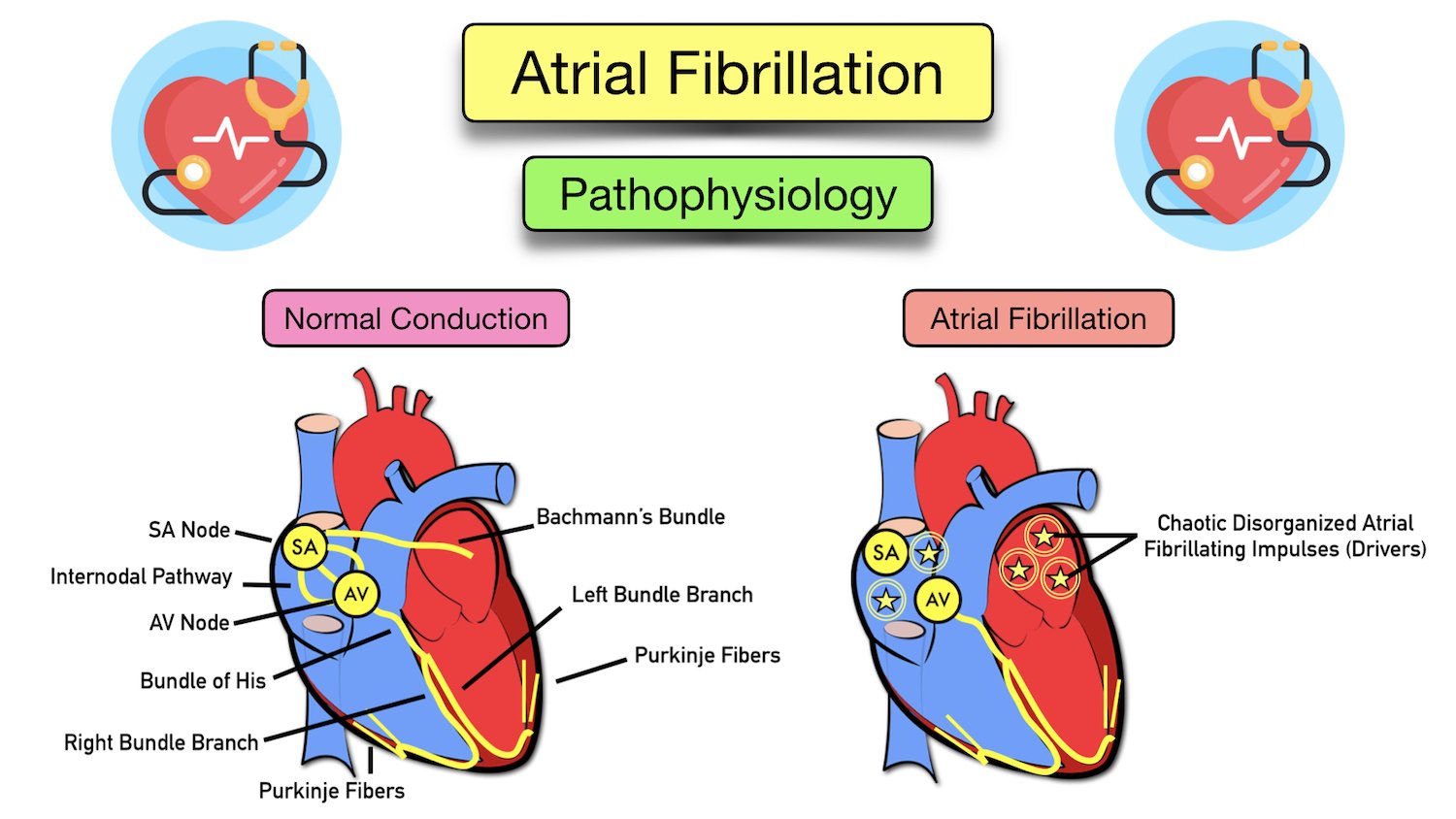 Atrial Fibrillation Symptoms Ecg Causes Treatment Definition