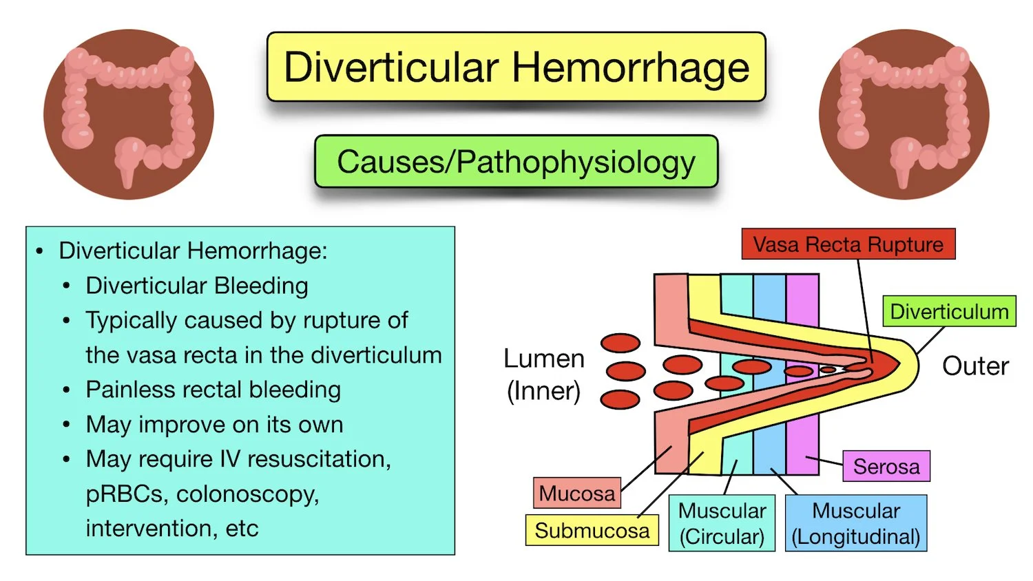Diverticular Disease Diverticulitis vs Diverticulosis Symptoms, Diet