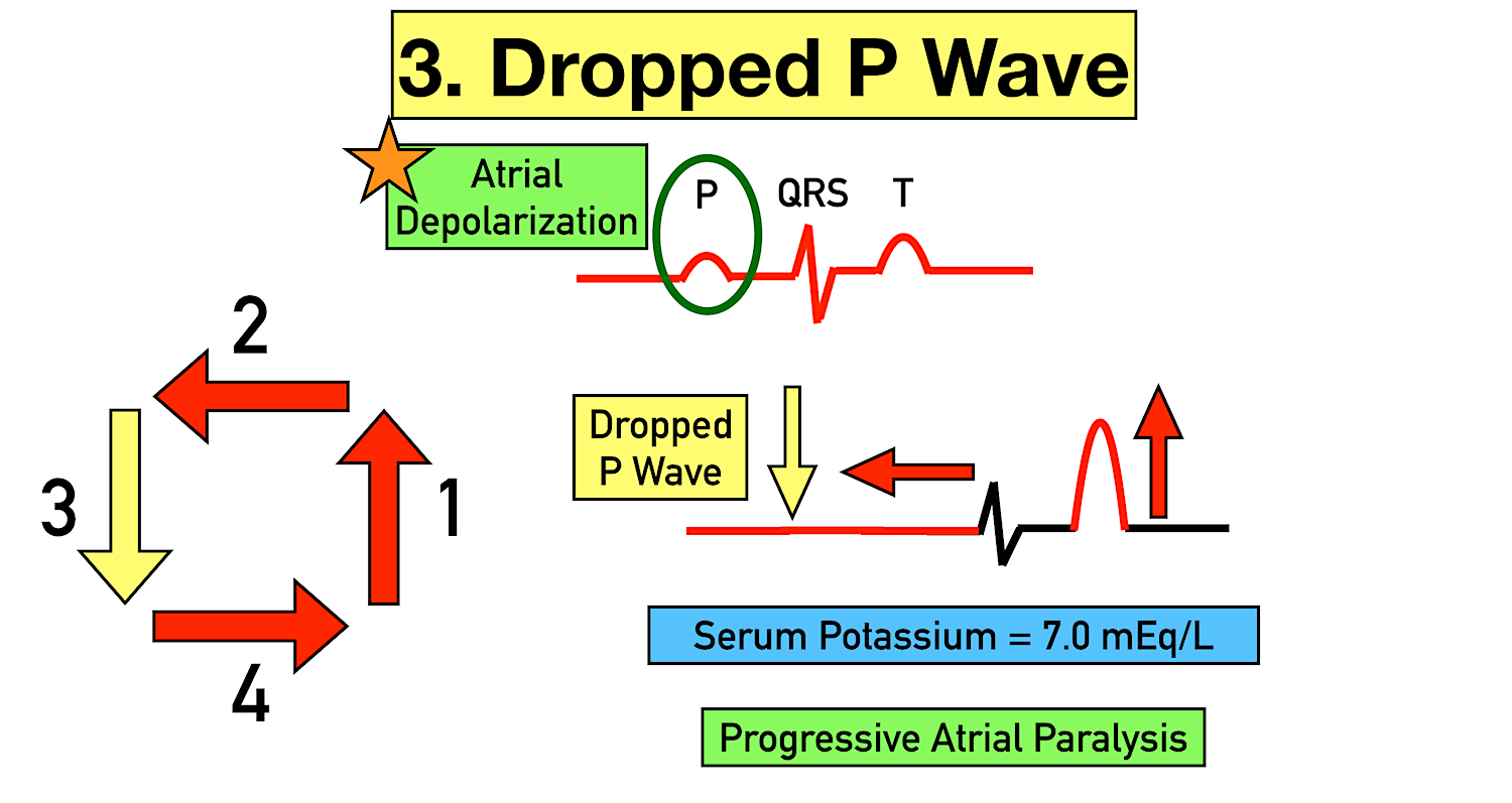 Hyperkalemia ECG Changes, Findings, and Progression of Effects on the