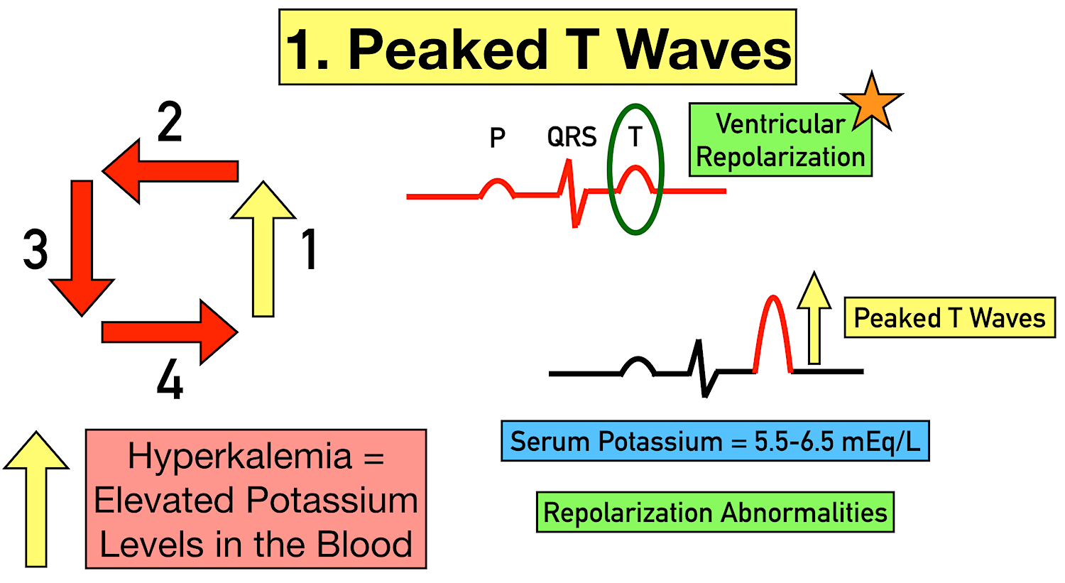 Hyperkalemia ekg