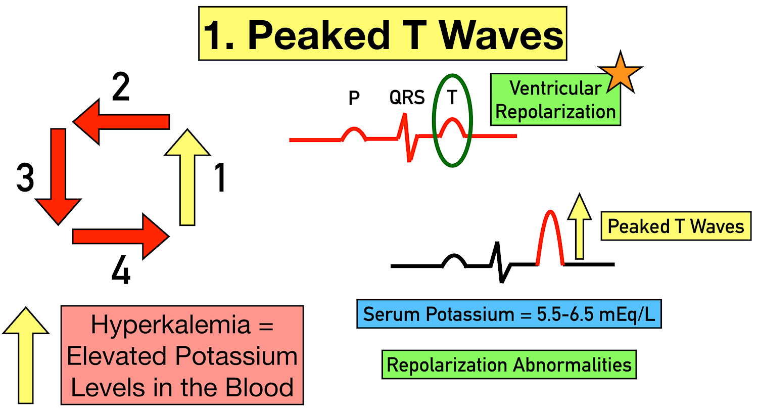 Hyperkalemia Ecg Changes Findings And Progression Of Effects On The