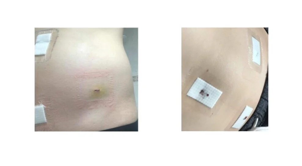 Photos from after my first laparoscopic surgery - June 2017.&nbsp;[Photo: Aliesha Tyler]