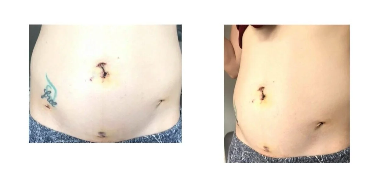 Photos post-surgery. [PhotoAliesha Tyler]