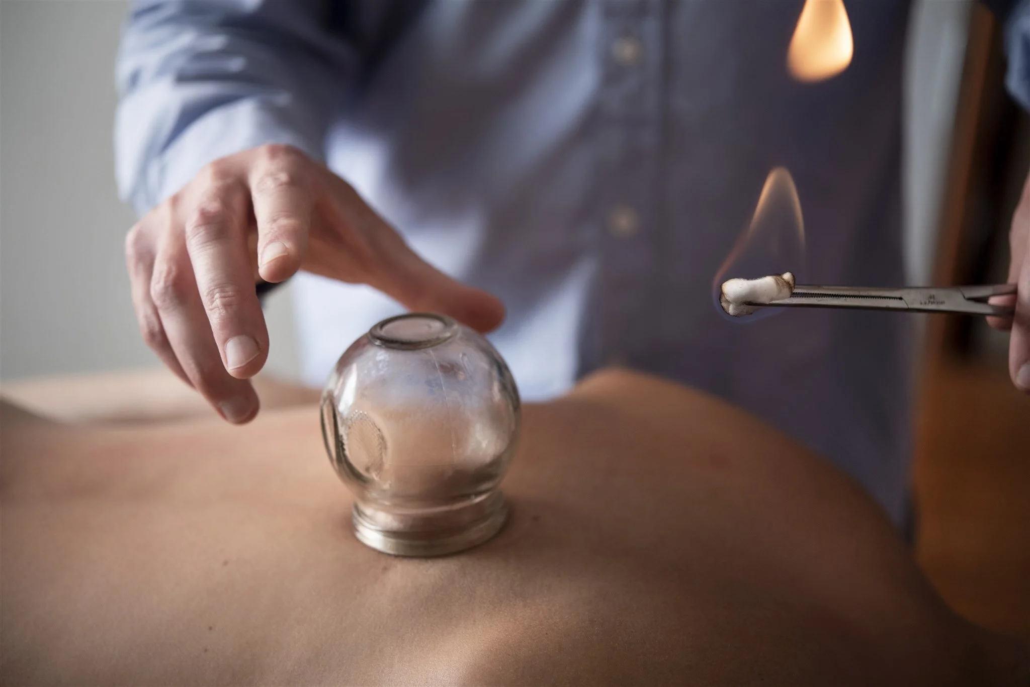 cupping-for-back-pain-nyc.jpg.jpg