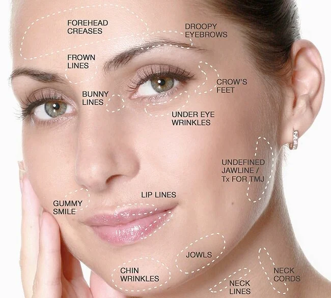 anti wrinkle injections under eyes