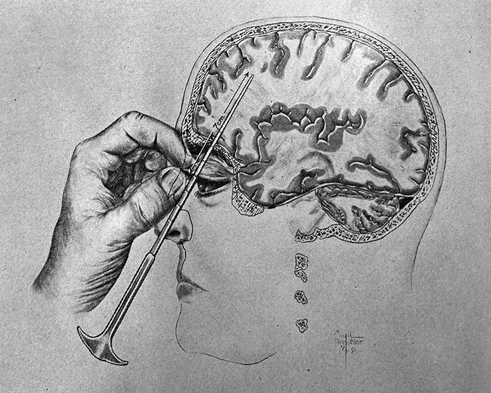 diagram-showing-walter-freemans-transorbital-lobotomy-x.jpg