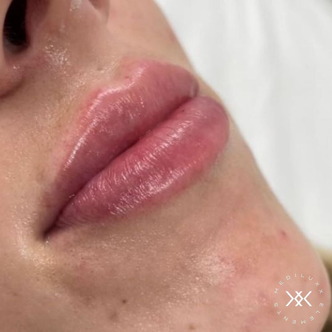 February promotions are still available 💉
⠀⠀⠀⠀⠀⠀⠀⠀⠀
0.6mL Lip Filler just $349
1mL Thick Lip Filler just $499 
⠀⠀⠀⠀⠀⠀⠀⠀⠀
Link in bio to book your appointment. #MediluxxElements #MadeByMediluxx *T&amp;Cs apply.
⠀⠀⠀⠀⠀⠀⠀⠀⠀
⠀⠀⠀⠀⠀⠀⠀⠀⠀
⠀⠀⠀⠀⠀⠀⠀⠀⠀
⠀⠀⠀⠀⠀⠀⠀⠀⠀
