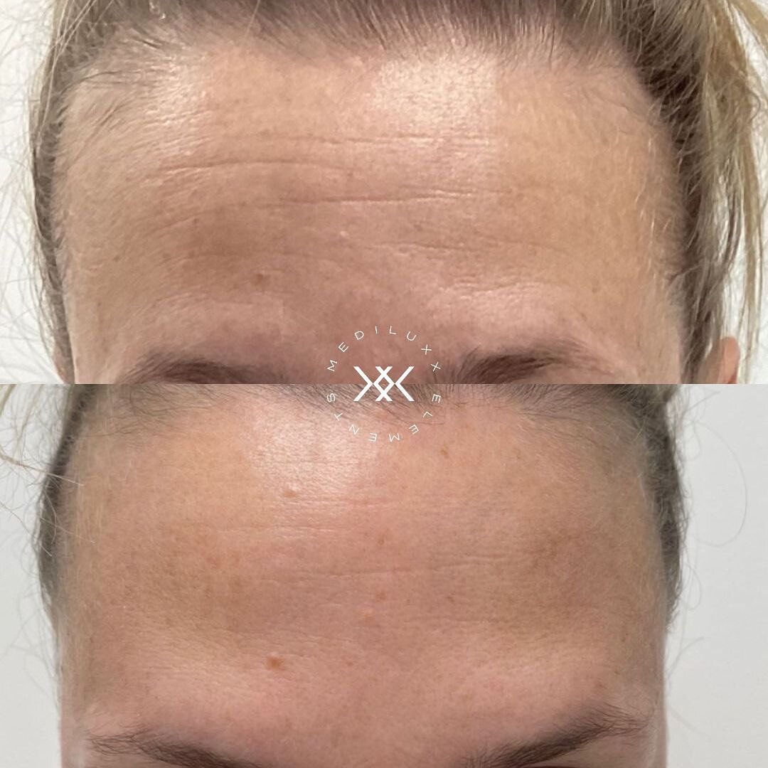 Anti-wrinkle injections are designed to prevent the skin from forming wrinkles. 
⠀⠀⠀⠀⠀⠀⠀⠀⠀
Our Anti-wrinkle injections are used to stop the injected muscles from contracting, which result in softening of wrinkles and fine lines. This results in a tig