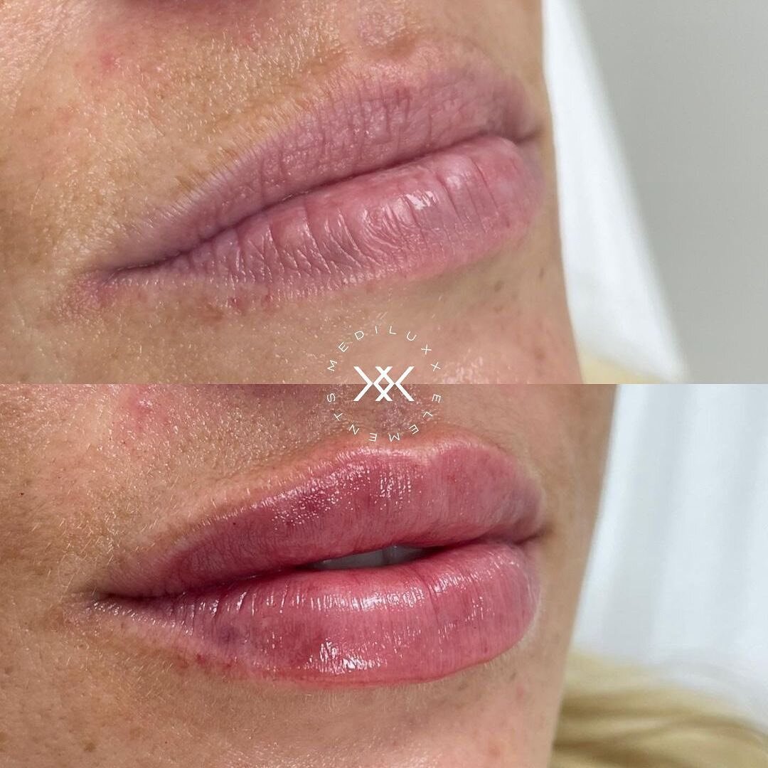 Aren't these beautiful? @rhiannaaesthetics used 1mL of Dermal Filler to hydrate and add shape to these natural-looking lips. 
⠀⠀⠀⠀⠀⠀⠀⠀⠀
Link in bio to book your appointment. #MediluxxElements #MadeByMediluxx 
⠀⠀⠀⠀⠀⠀⠀⠀⠀
⠀⠀⠀⠀⠀⠀⠀⠀⠀
⠀⠀⠀⠀⠀⠀⠀⠀⠀
⠀⠀⠀⠀⠀⠀⠀⠀⠀
⠀