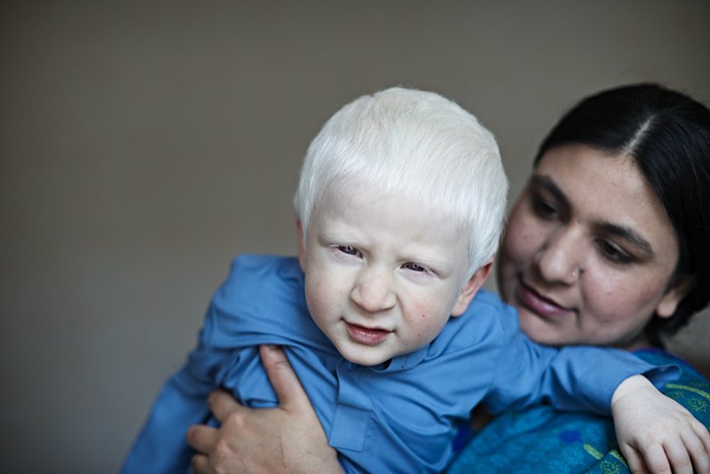 Living With Albinism by John Ferguson