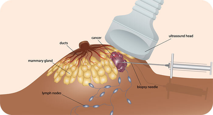 Breast Procedures — Keller Surgical Specialists