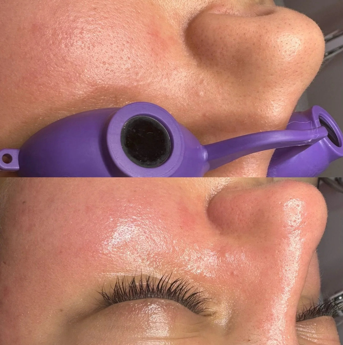 Before and after nose extractions 👃🏼#nikaaesthetician 

#skin #skincare #facial #lafacials #laesthetician #esthetician #nose #extractions #blackheads #whiteheads #oil #pores #losangeles #shermanoaks #vannuys #bookyourappointment #booktoday #beforea