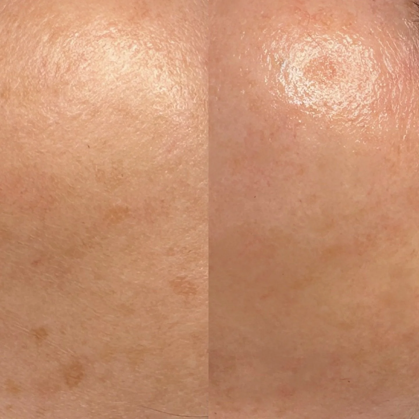This is what happens when you stay consistent with your home-care regimen✨
These results are from 3 monthly facials and a customized skincare regimen specifically geared towards hyperpigmentation. 
#nikaaesthetician 

#skin #skincare #beforeandafter 