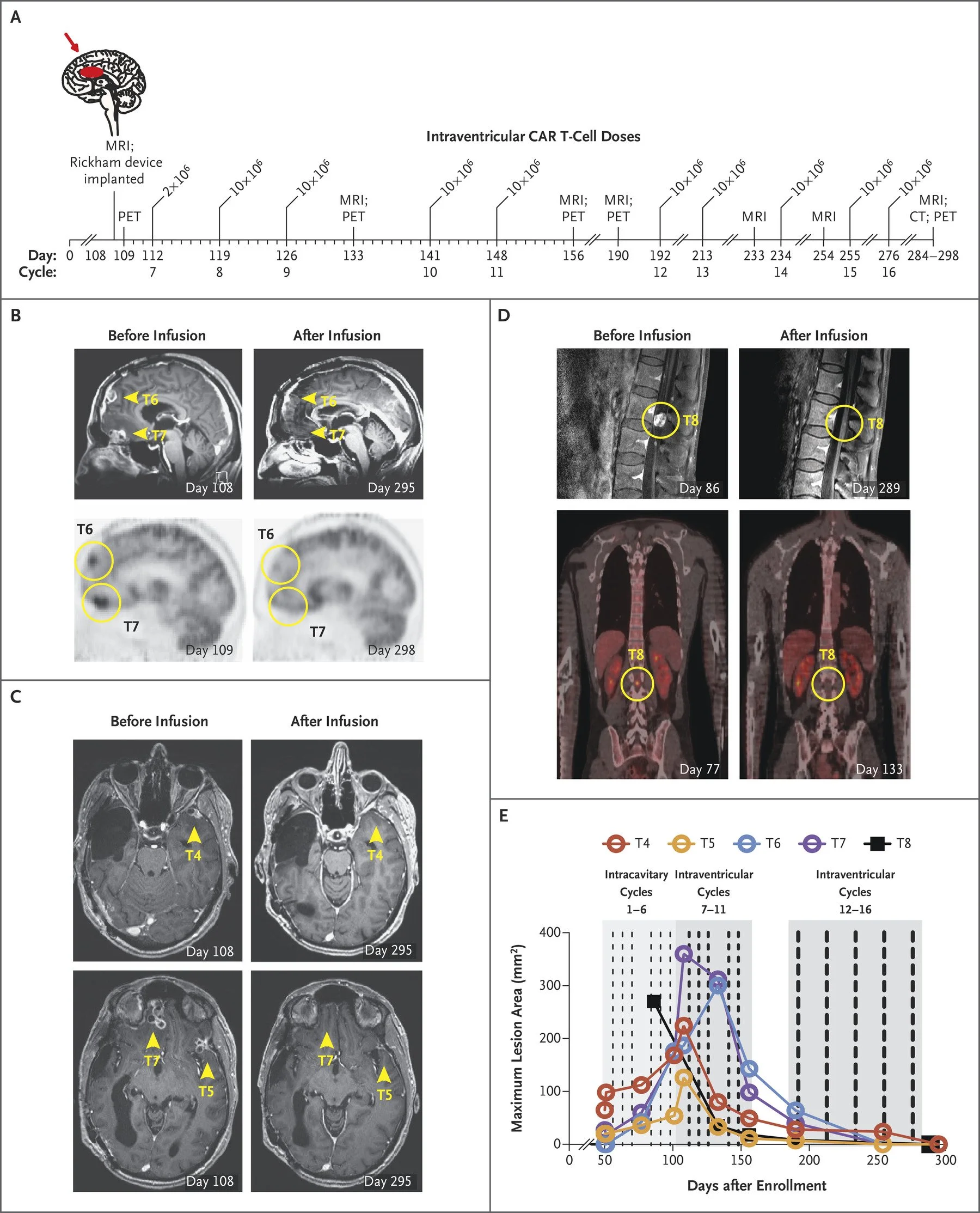 Come funziona Car-T, la terapia che usa il sistema immunitario contro i tumori