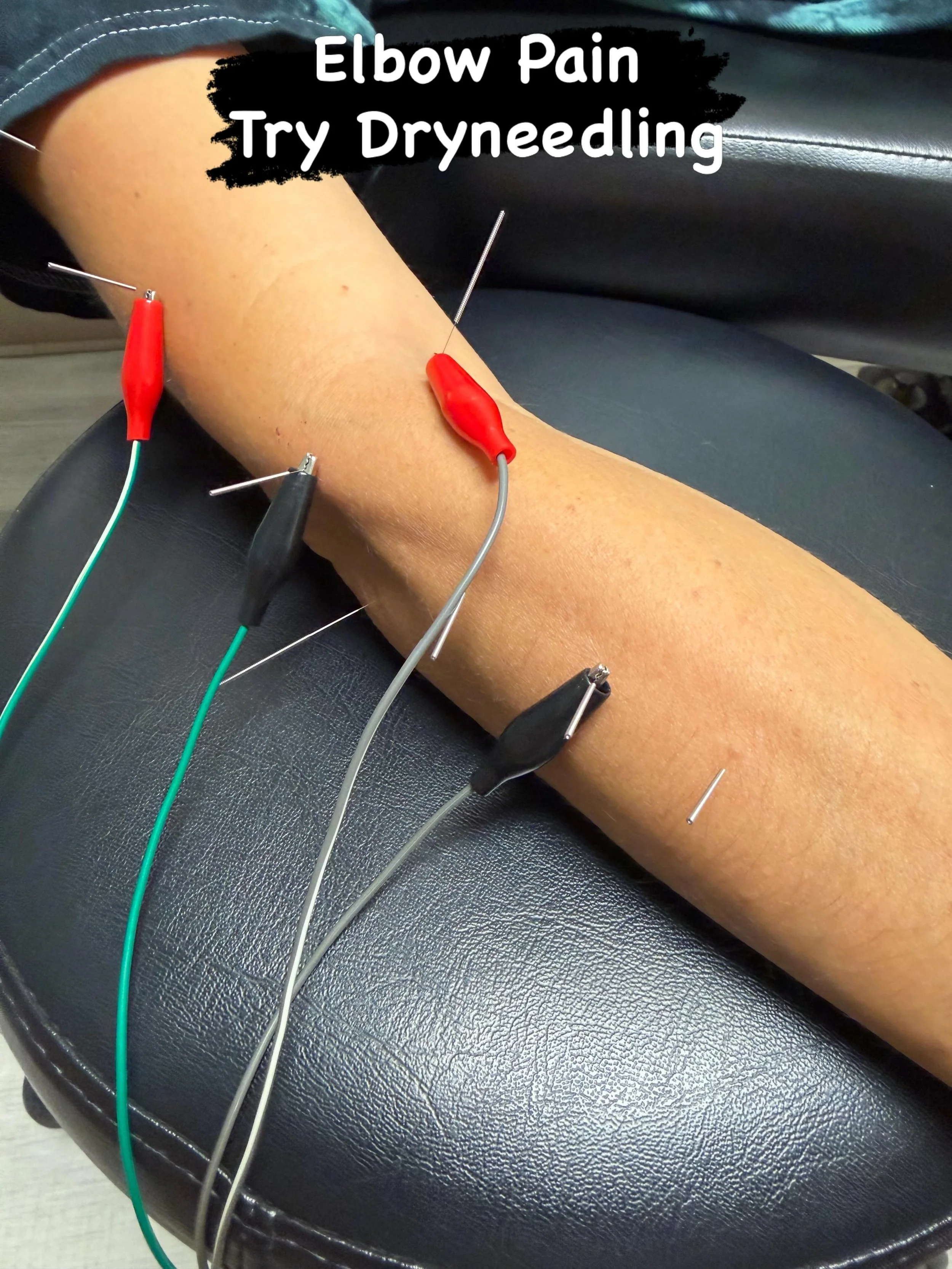 🎾 Tennis Elbow Slowing You Down?
Pain on the outside of the elbow when gripping, lifting, or even shaking hands could be lateral epicondylitis &mdash; commonly known as tennis elbow.

Dry needling can help:
✔️ Reduce muscle tension
✔️ Improve blood 