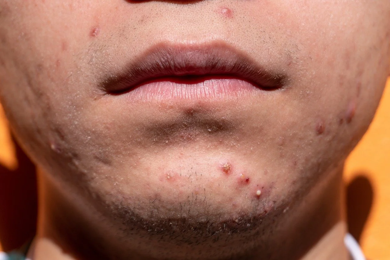 How can you treat acne and anxiety-induced flare-ups with Sokörpe Skin-Care?