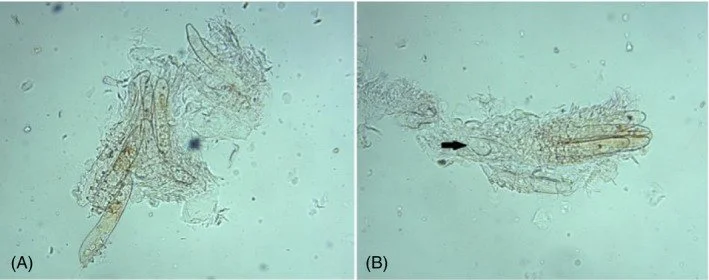 What Is Demodicosis (Infestation of Hair Follicles by Demodex Mites)