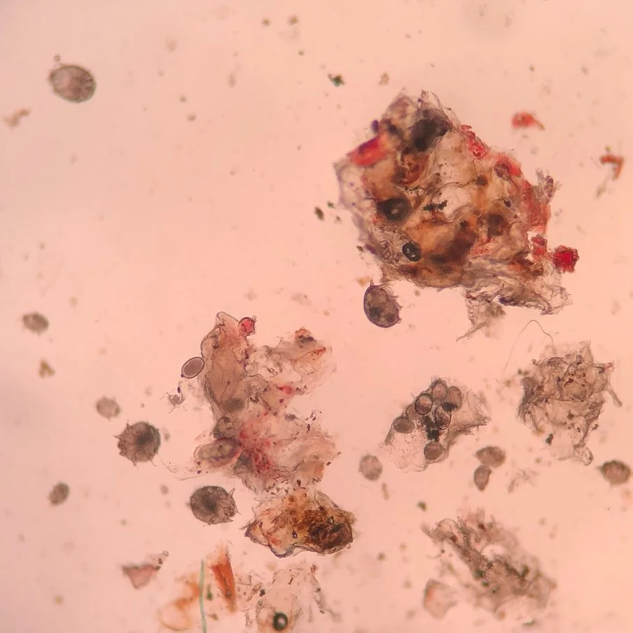 What Is Sarcoptic Mange (Infestation of Sarcoptes Mites on Animals, Including Humans)