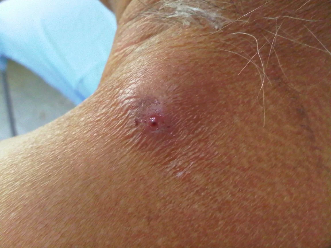 What Is Myiasis (Infestation by Fly Larvae)