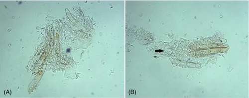 What Is Demodicosis (Infestation of Hair Follicles by Demodex Mites ...
