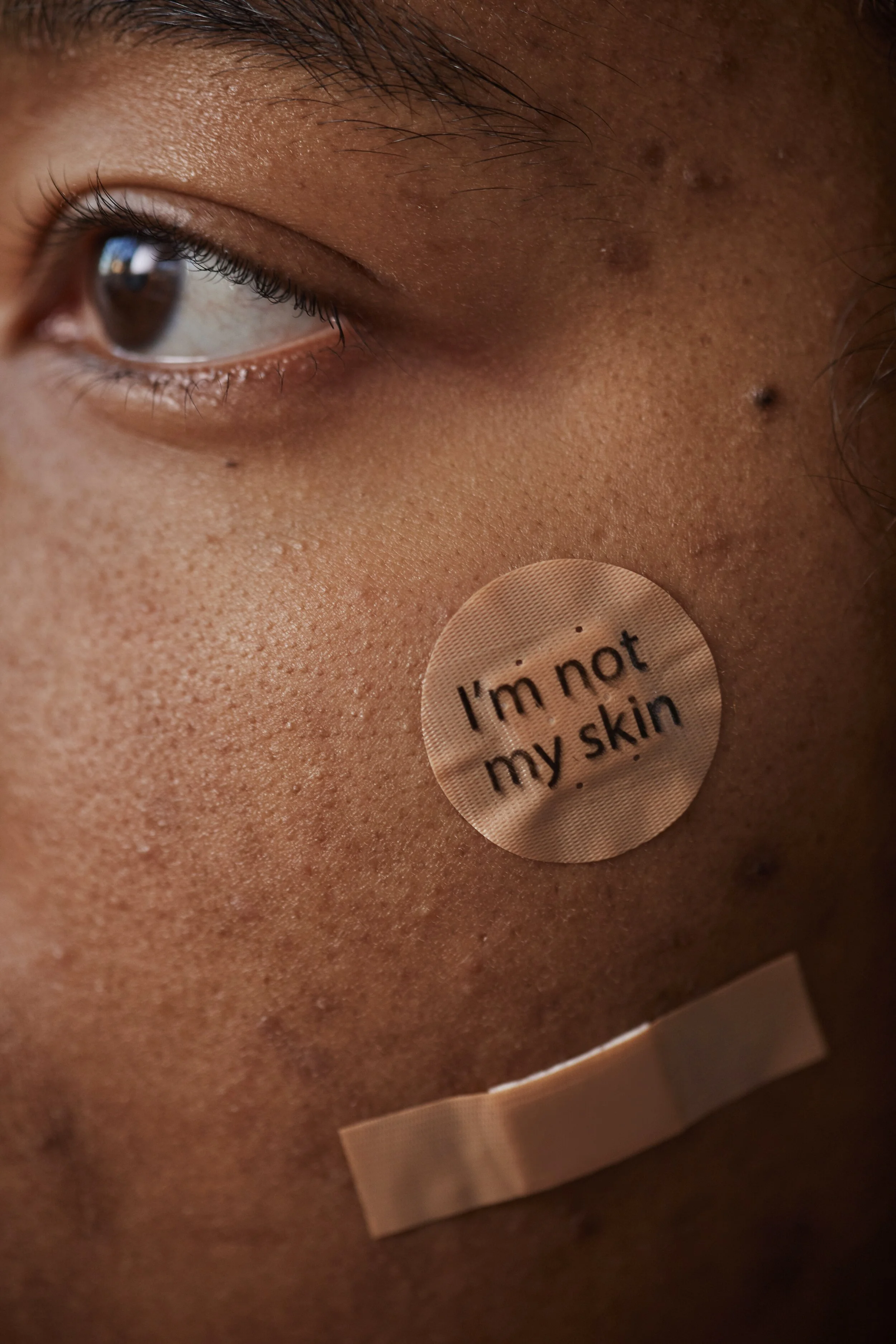 Accepting Adult Acne 