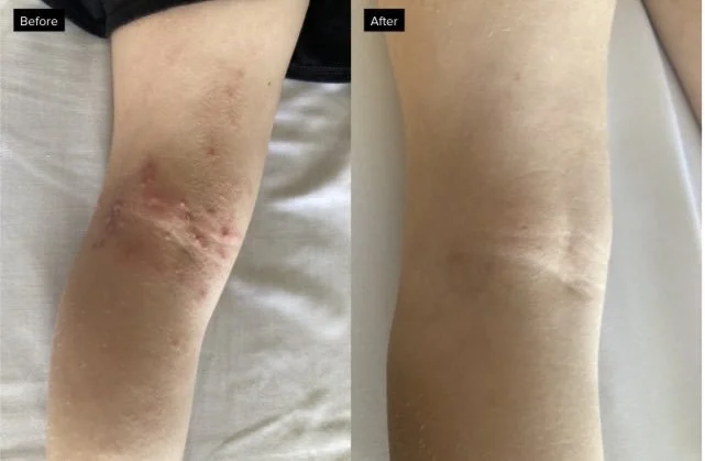 Light and Dark Acupuncture