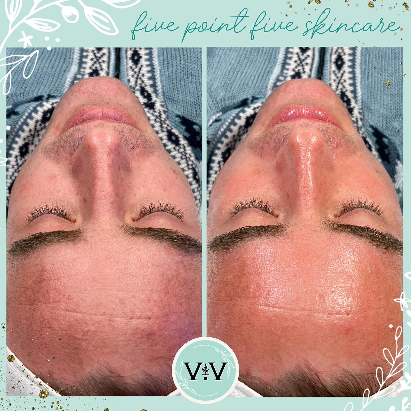 Nothing like a HydraFacial treatment to bring the skin back to life 🤩

3-steps and 30 min was all it took to transform this client from feeling dull, dehydrated, and congested to having a bright, healthy, hydrated complexion.

STEP O1 -  CLEANSE &am