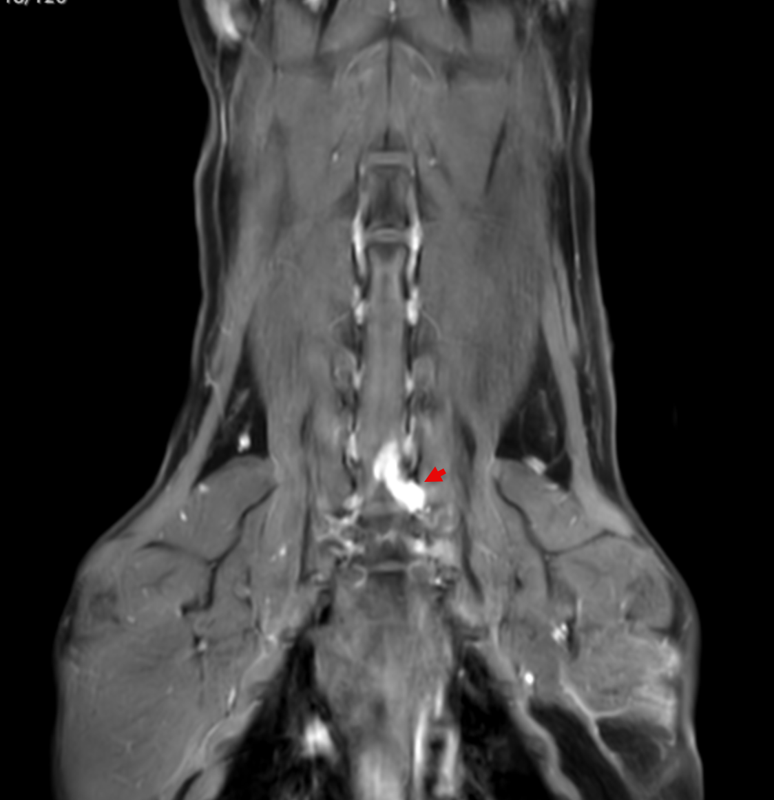 Dorsal post-contrast MRI of a dog cervical spine showing enhancing lesion at C7 to T1 nerve roots extending into the brachial plexus