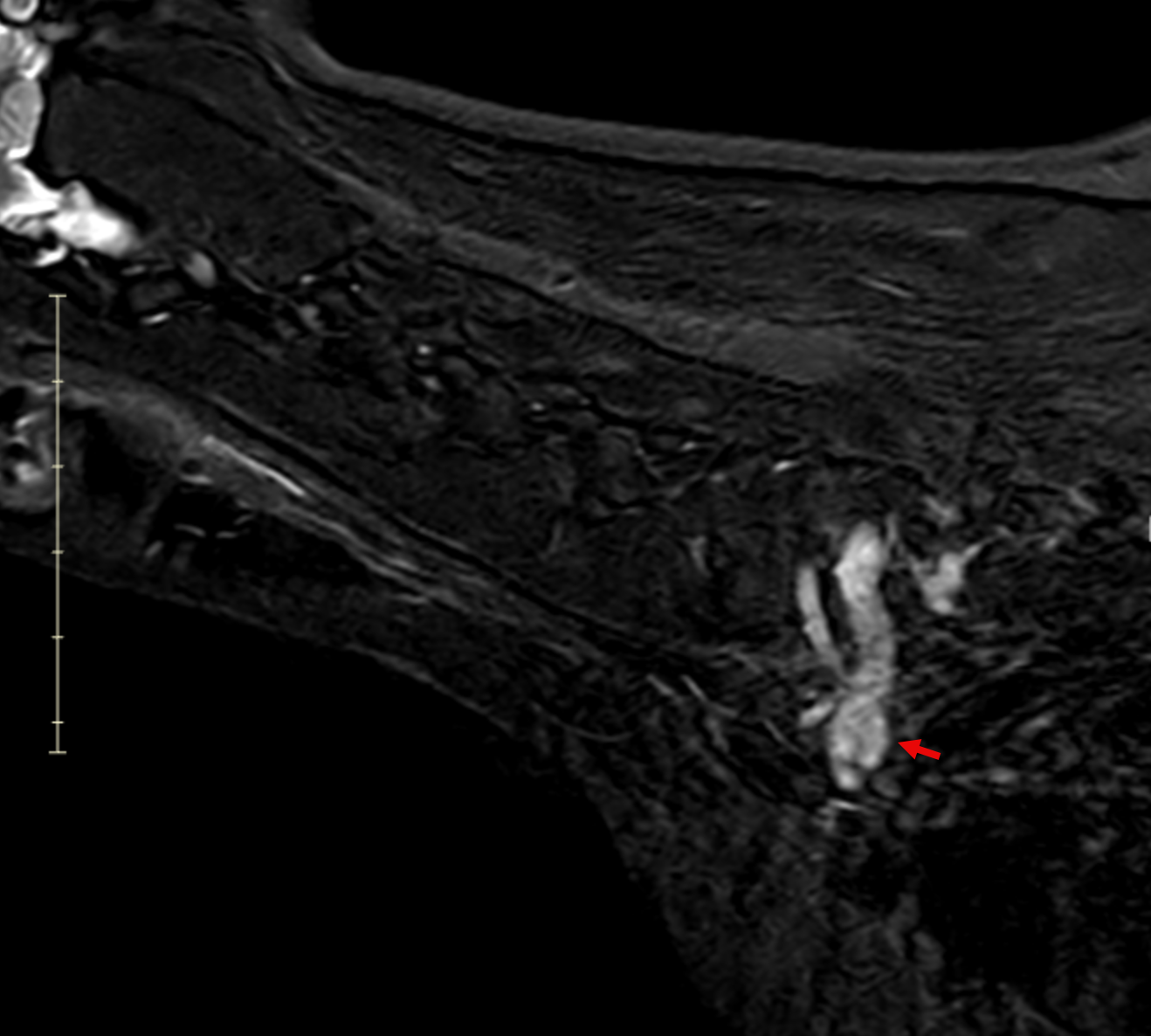 Sagittal post-contrast MRI of a dog showing tubular mass along cervical nerve roots with spinal cord compression