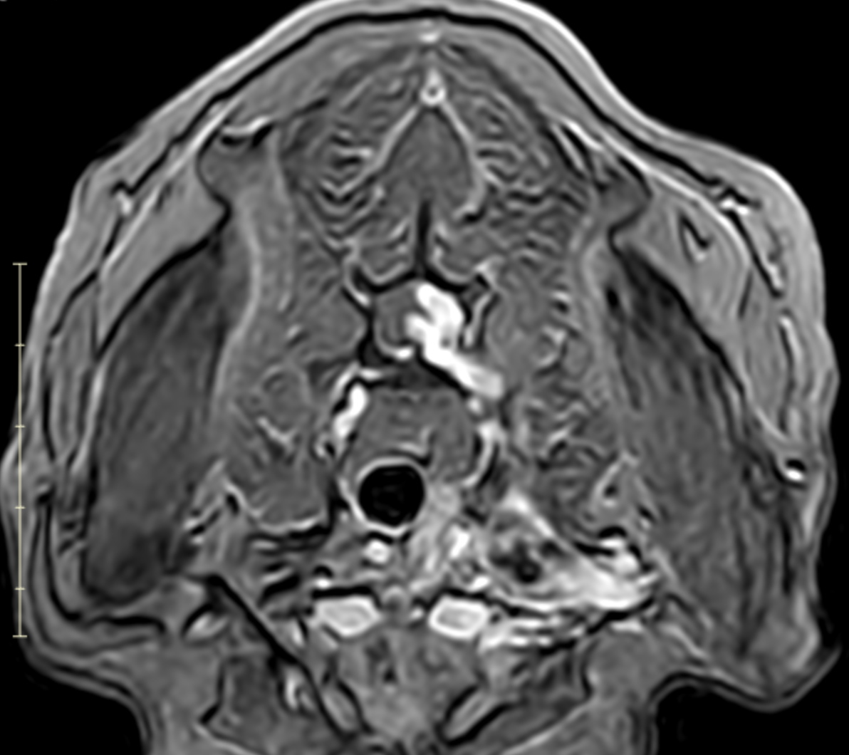 Transverse MRI of a dog showing enlarged C7 to T1 nerve roots with contrast enhancement and spinal cord displacement