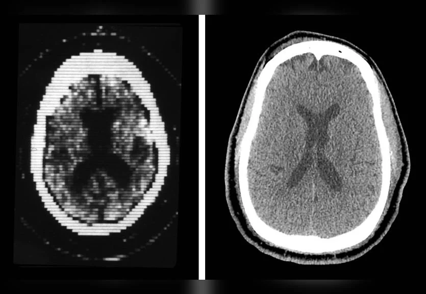 Side-by-side comparison of early CT imaging and modern scan quality.Image courtesy of Yale School of Medicine