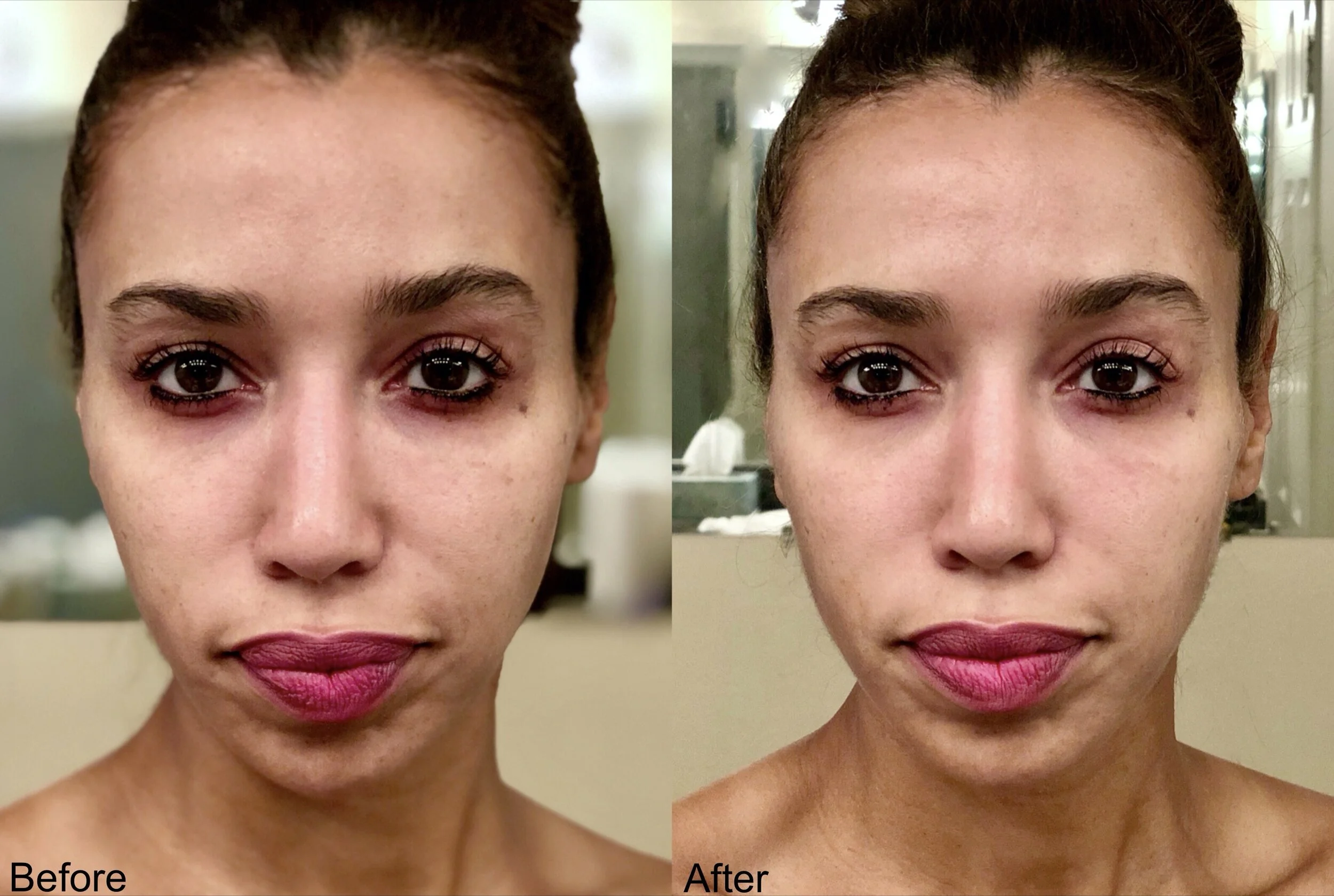 Before & After BOTOX, Fillers, Chemical Peels Natural Injector