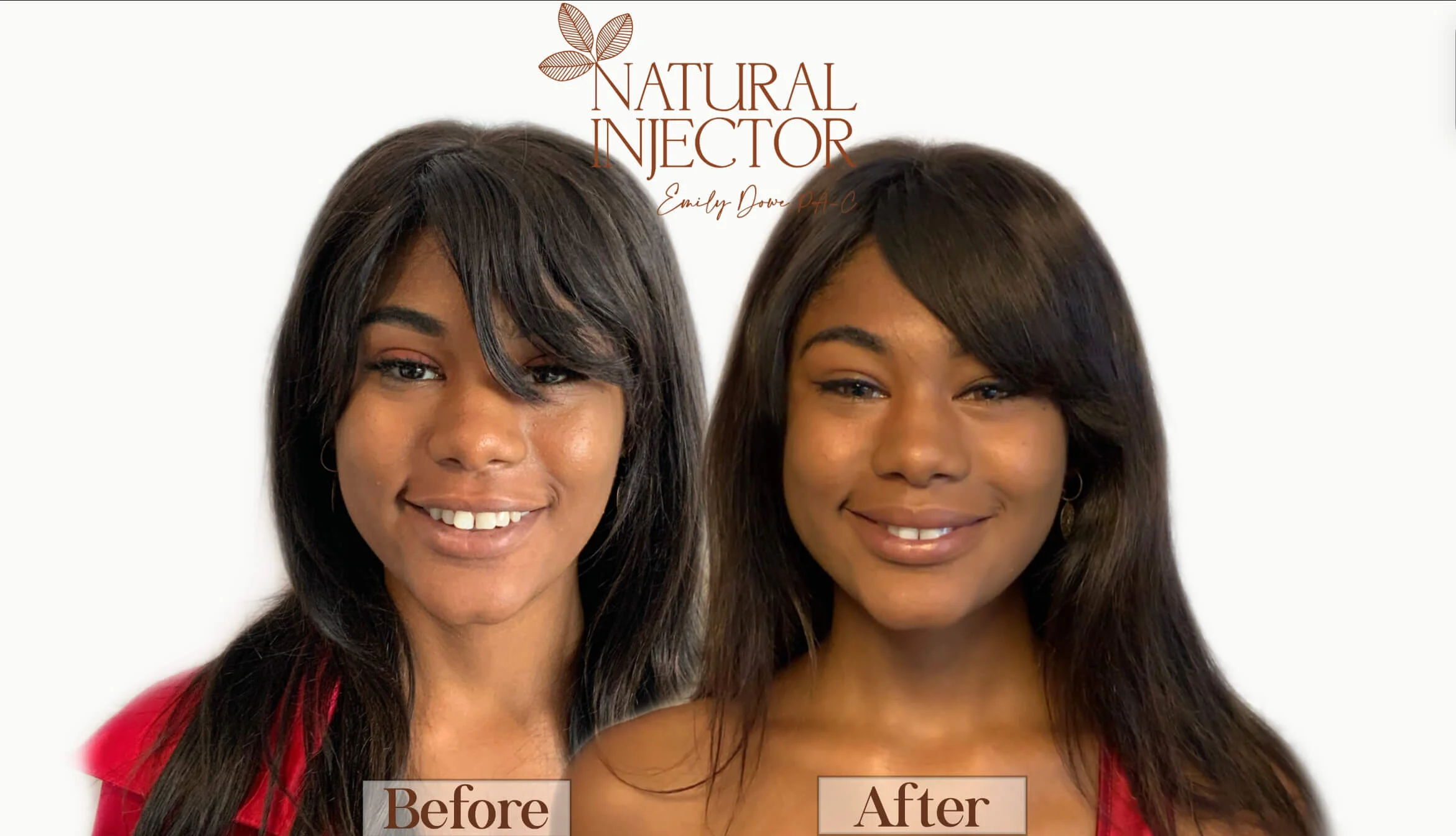 Before & After BOTOX, Fillers, Chemical Peels Natural Injector