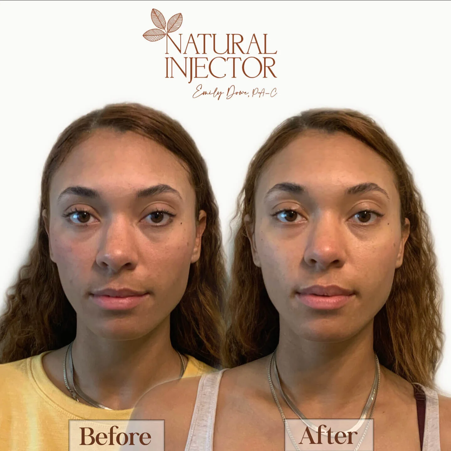 Before & After BOTOX, Fillers, Chemical Peels Natural Injector