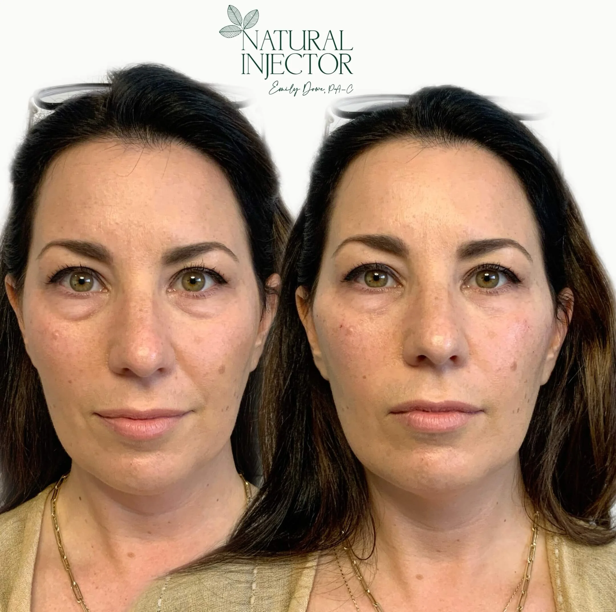 Before & After BOTOX, Fillers, Chemical Peels Natural Injector