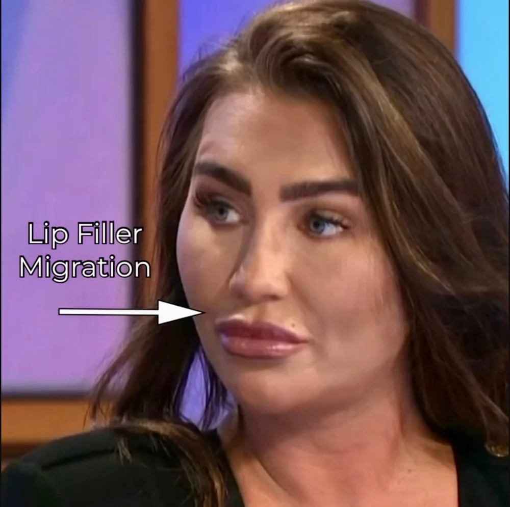 3 Signs 🛑 you have Lip Filler Migration — Natural Injector