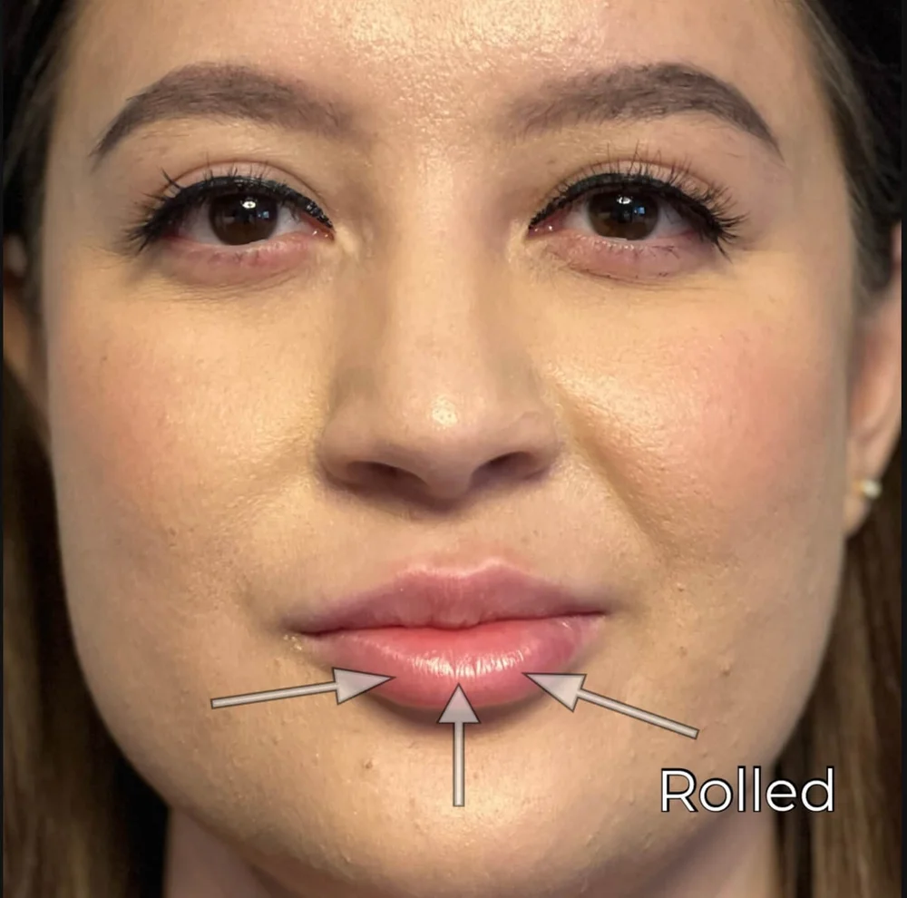 3 Signs 🛑 you have Lip Filler Migration — Natural Injector