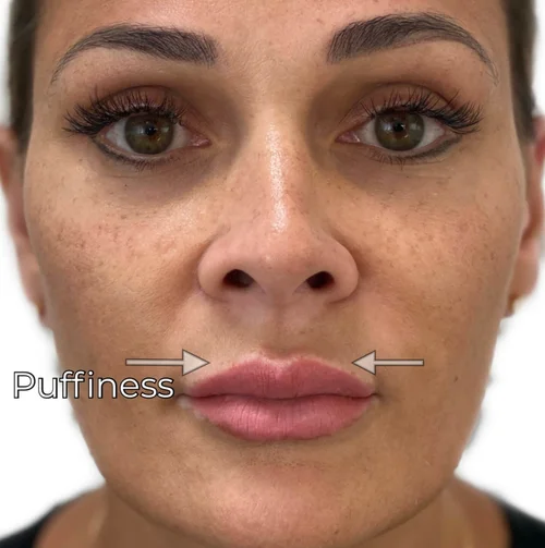 3 Signs 🛑 you have Lip Filler Migration — Natural Injector