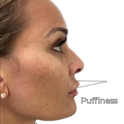 3 Signs 🛑 you have Lip Filler Migration — Natural Injector