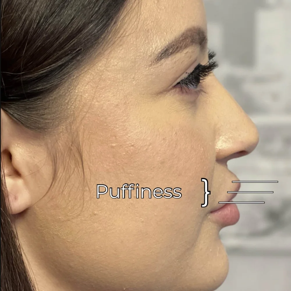 3 Signs 🛑 you have Lip Filler Migration — Natural Injector