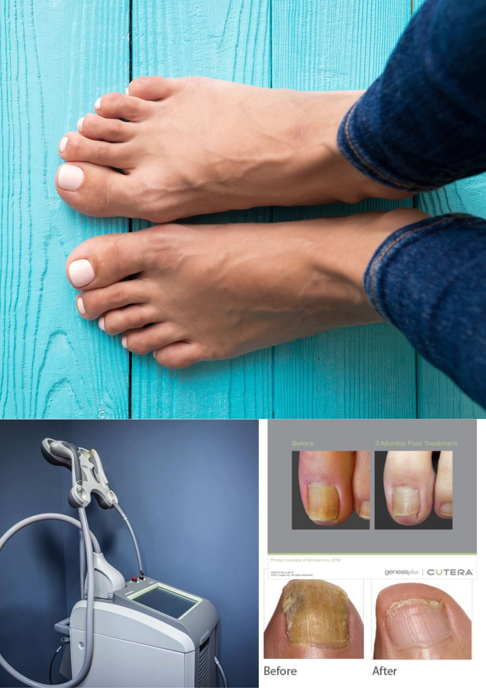Laser Fungal Nail Therapy — 2 Right Feet Podiatry | Yarra Valley Family  Podiatry & Remedial Massage
